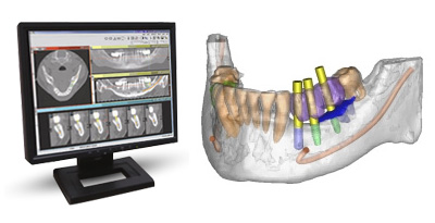 computer guided implant surgery