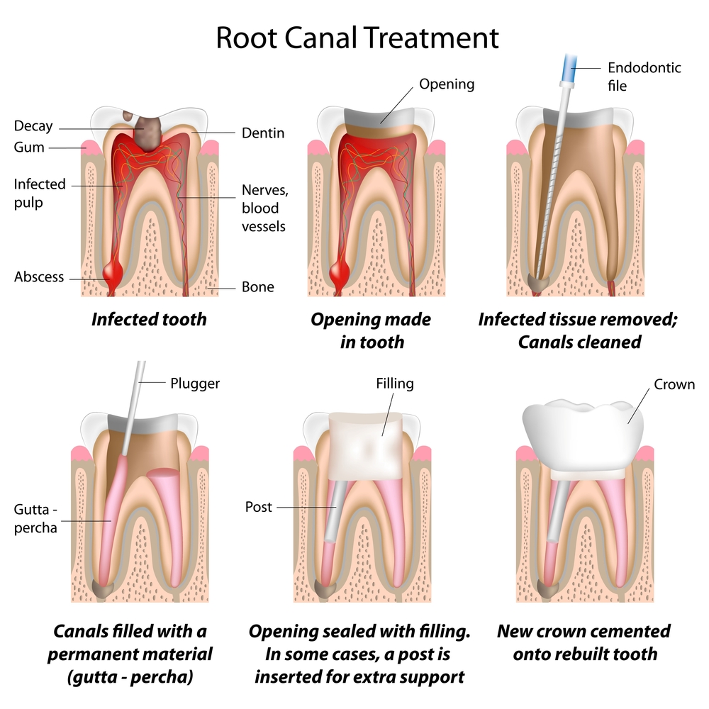 endodonticen