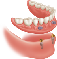 Implant Overdenture