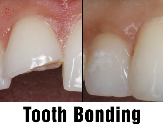tooth bonding
